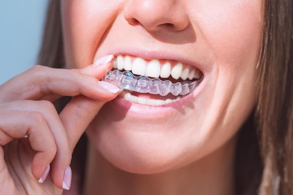 A woman smiles brightly while holding her clear aligners, showcasing her teeth with braces.