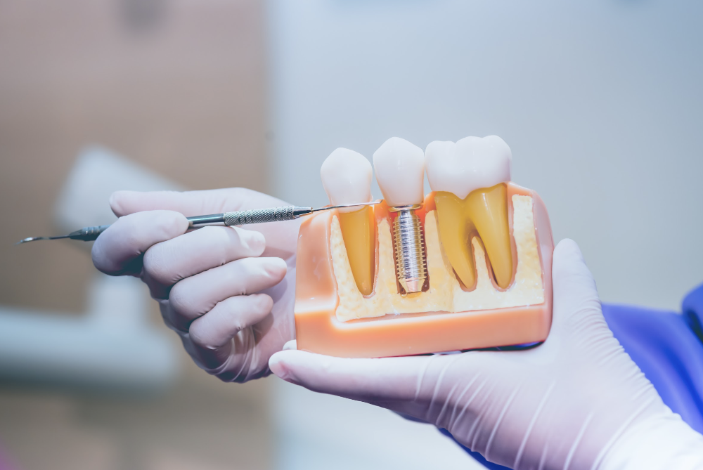 A hand displays a tooth model, highlighting dental implants offered at Scheske Family Dental.