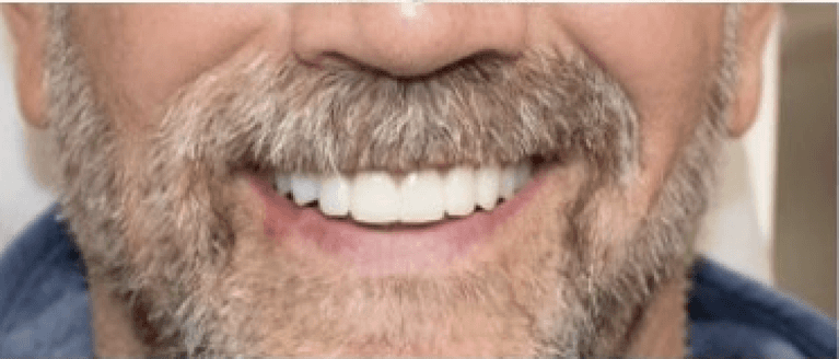 Full-Mouth-Reconstruction-Upper-Lower-After-Image