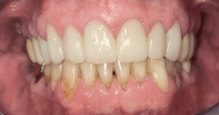 Crowns-After-Image
