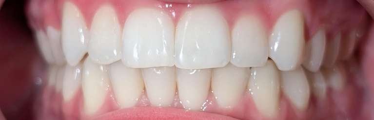 Clear-Aligners-After-Image