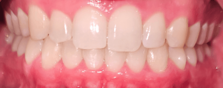 SureSmile-Clear-Aligner-After-Image