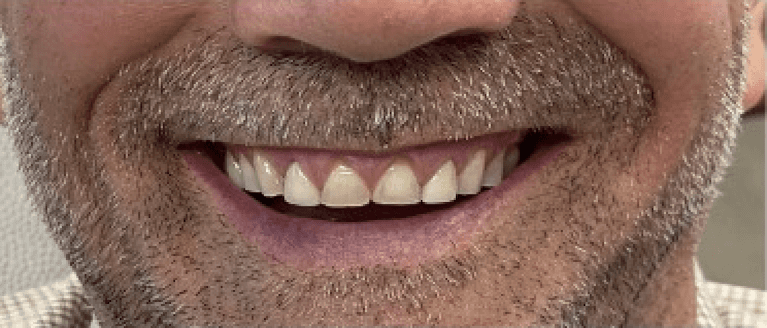 Full-Mouth-Reconstruction-Upper-Lower-Before-Image