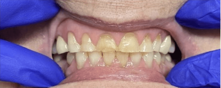 Full-Mouth-Reconstruction-Upper-Lower-Before-Image
