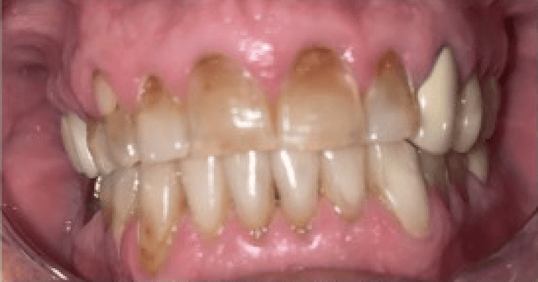 Crowns-Before-Image
