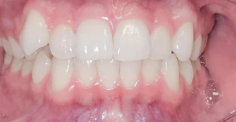 Clear-Aligners-Before-Image