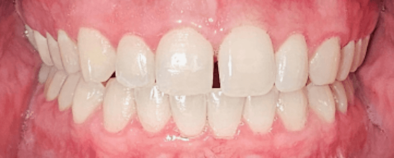 SureSmile-Clear-Aligner-Before-Image